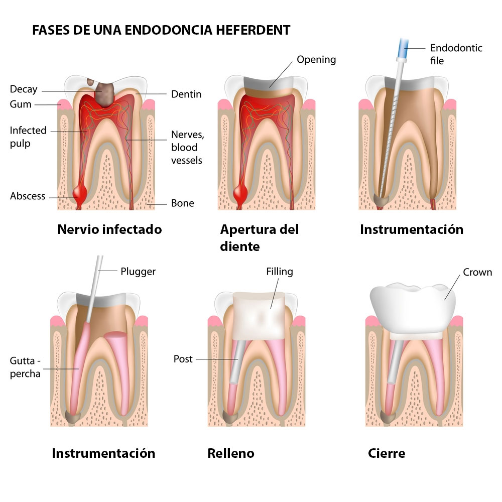 fases de la endodoncia infografía