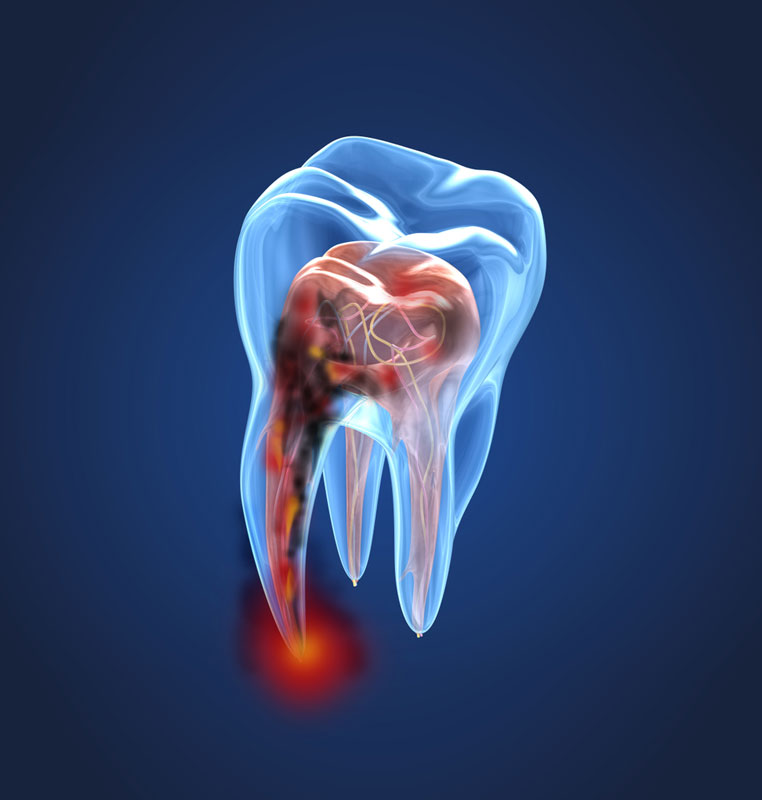 Endodoncia