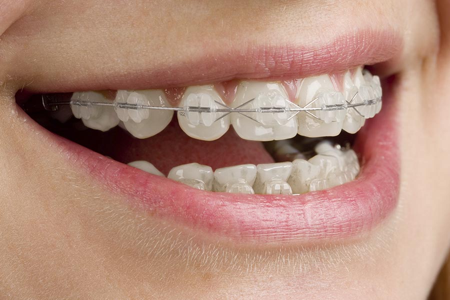 Ortodoncia con Brackets Estéticos
