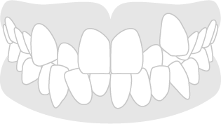 Apiñamiento dental