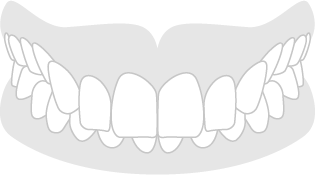Sobremordida