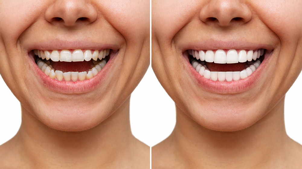 Blanqueamiento dental