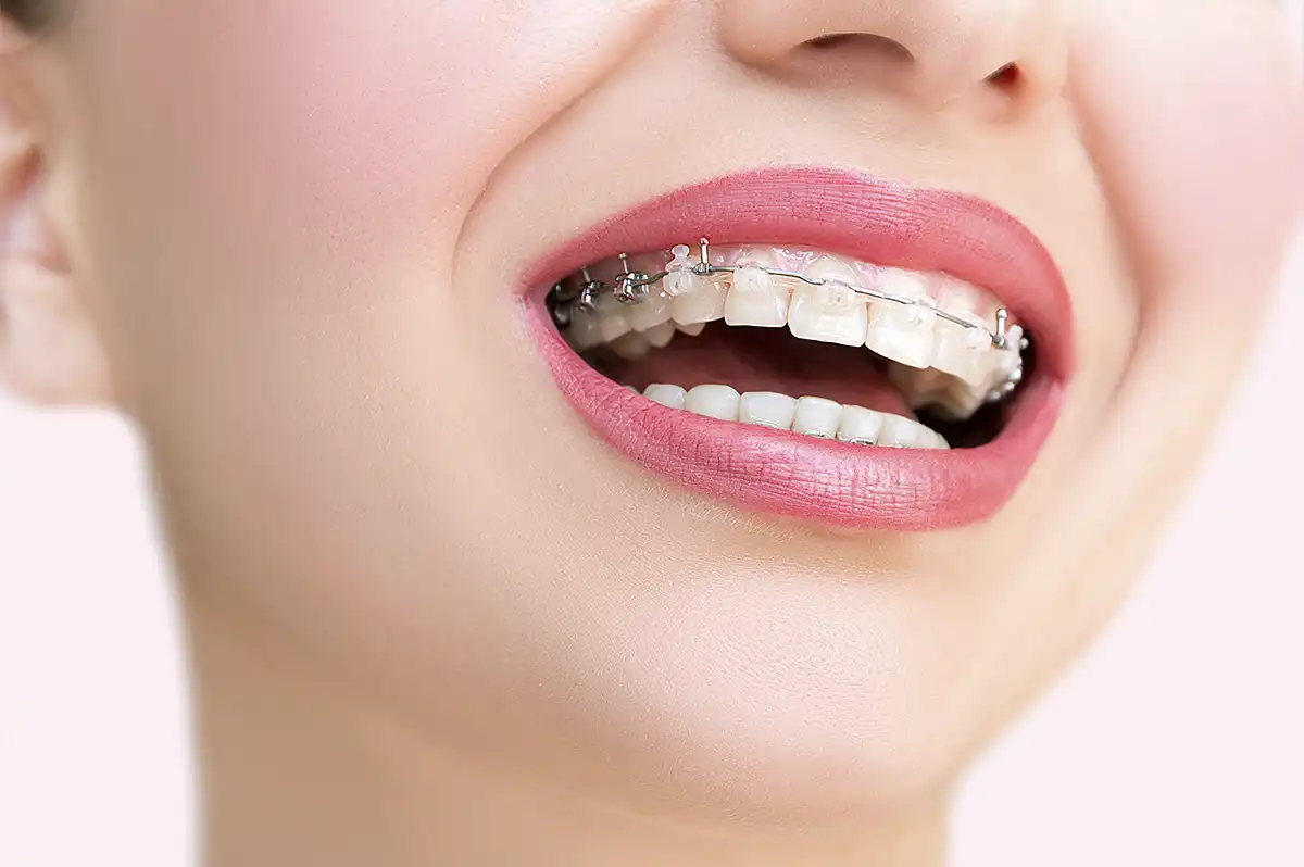 Brackets de autoligado estéticos