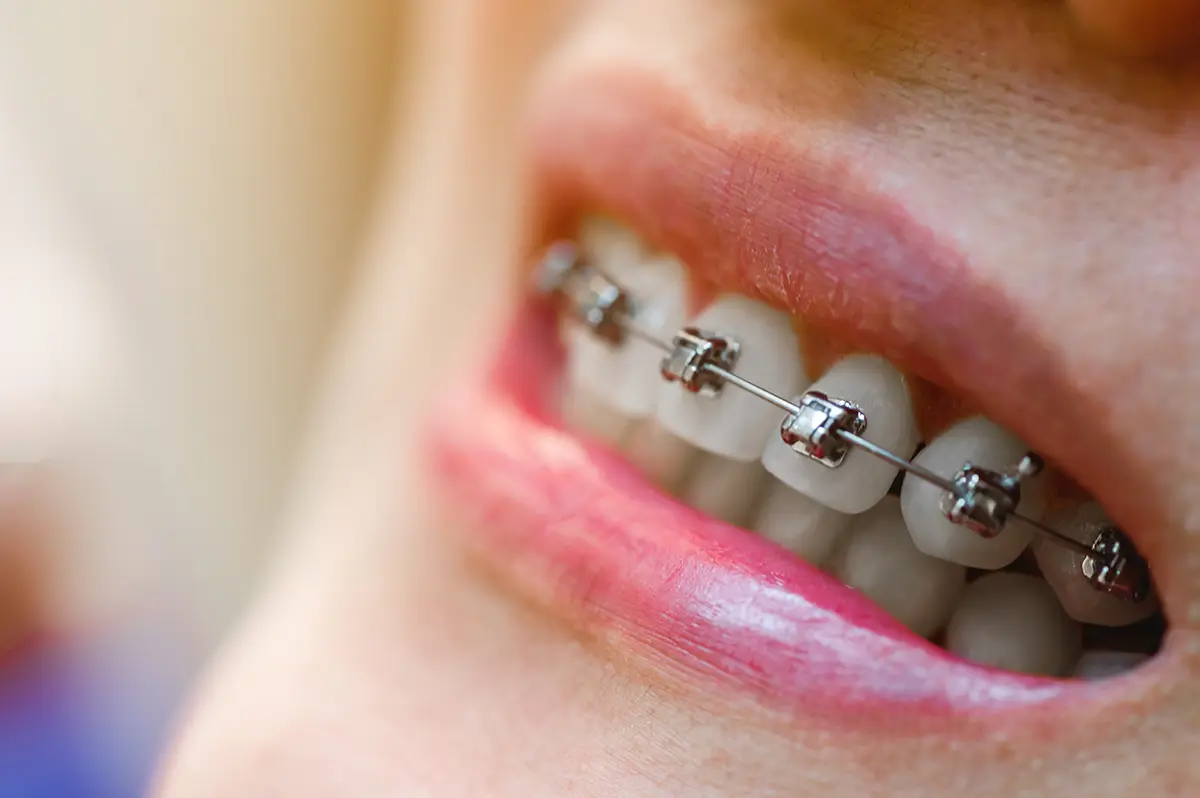 Brackets de autoligado metálicos