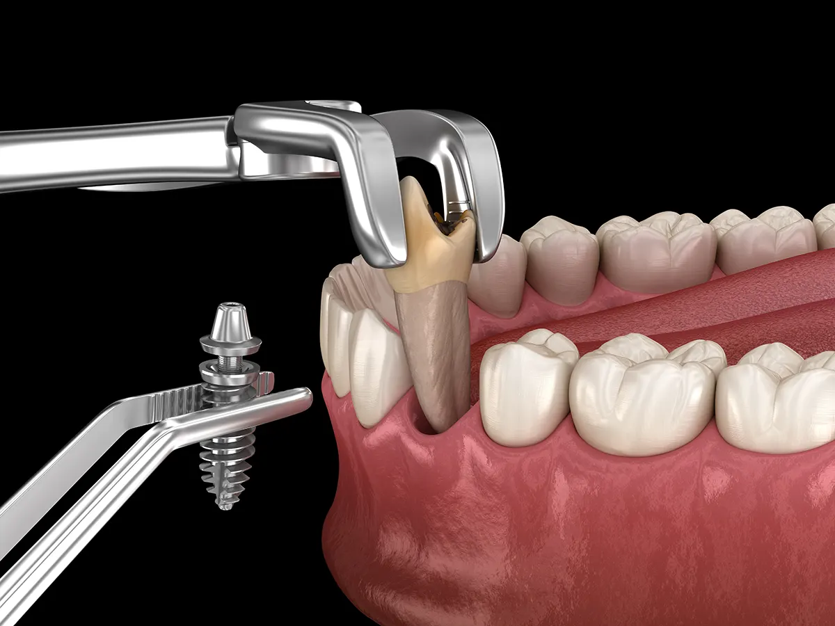 Colocación Implantes inmediatos