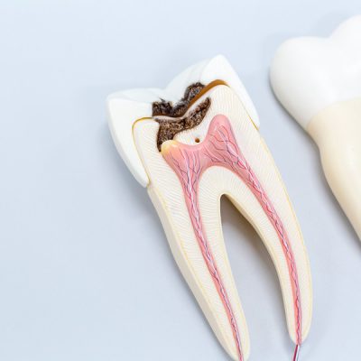 Cuándo es necesaria una endodoncia