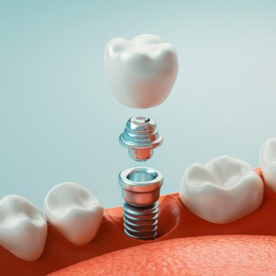 implante-dental implante-dental