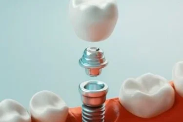 Implantes dentales unitarios y coronas implantosoportadas
