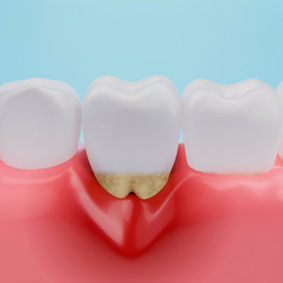 periodoncia periodoncia