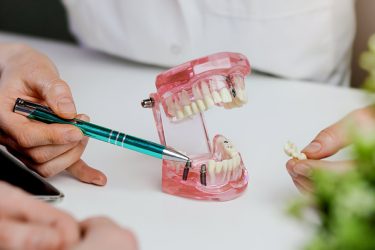 Puente sobre implantes